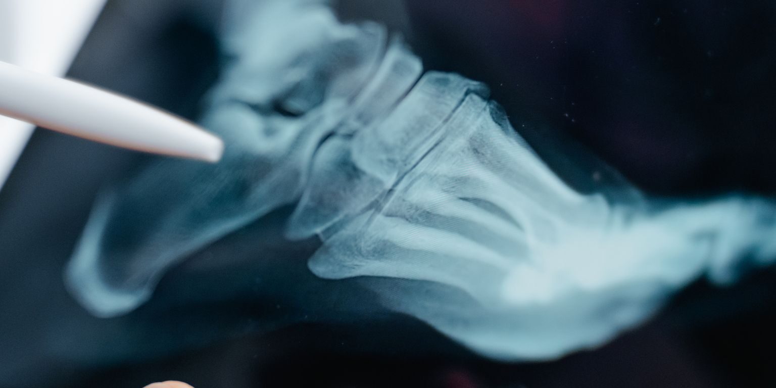 Closeup of a X-ray scan of a foot with a closed pen pointing toward the heel