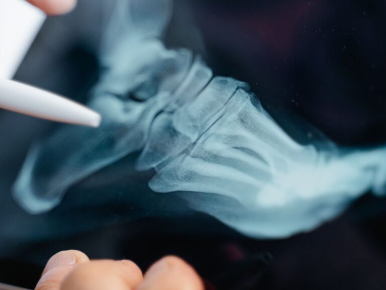 Closeup of a X-ray scan of a foot with a closed pen pointing toward the heel