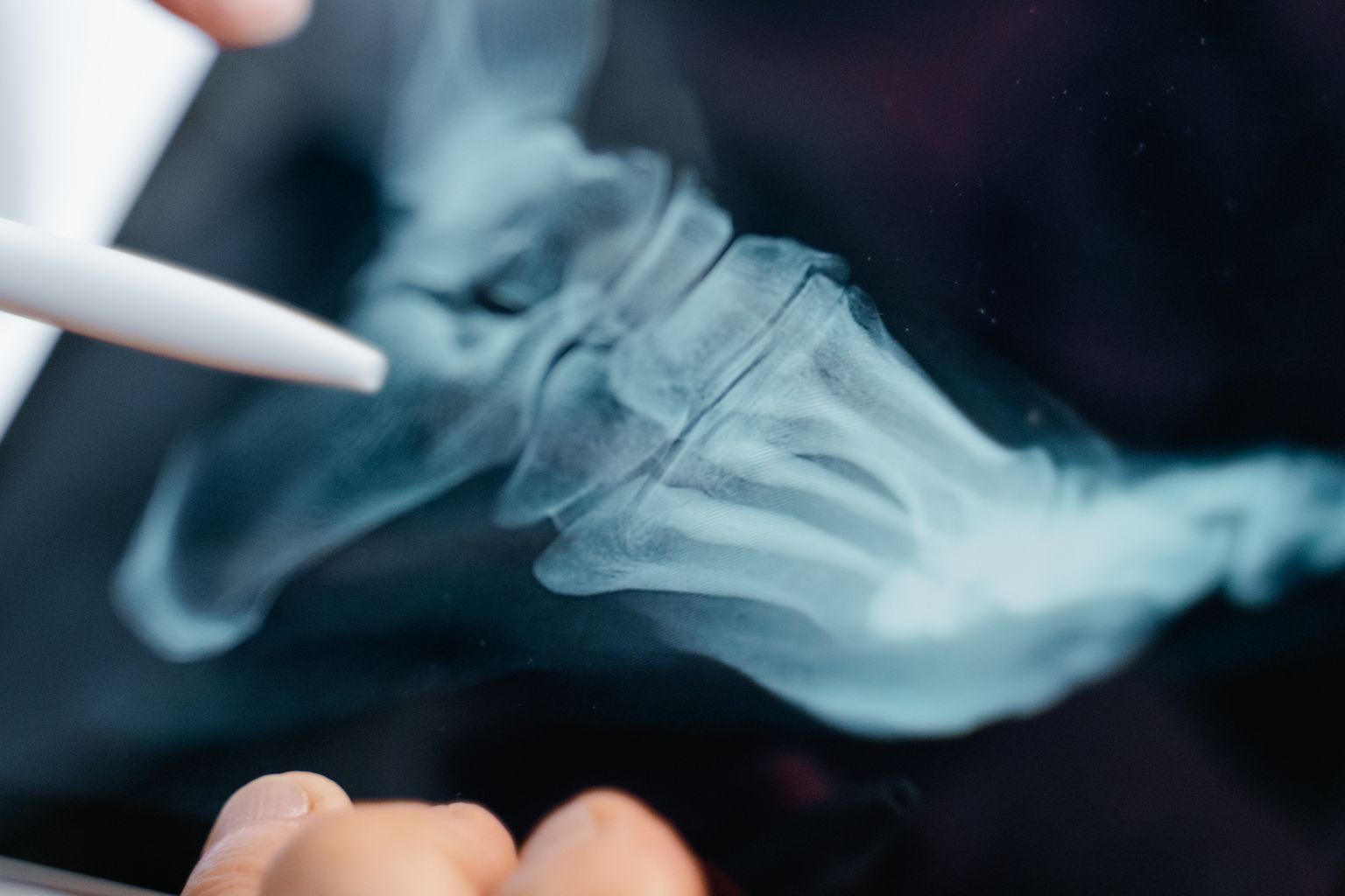 Closeup of a X-ray scan of a foot with a closed pen pointing toward the heel